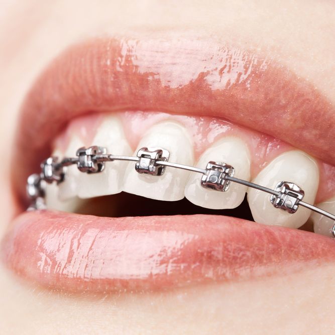 A person wearing metal braces