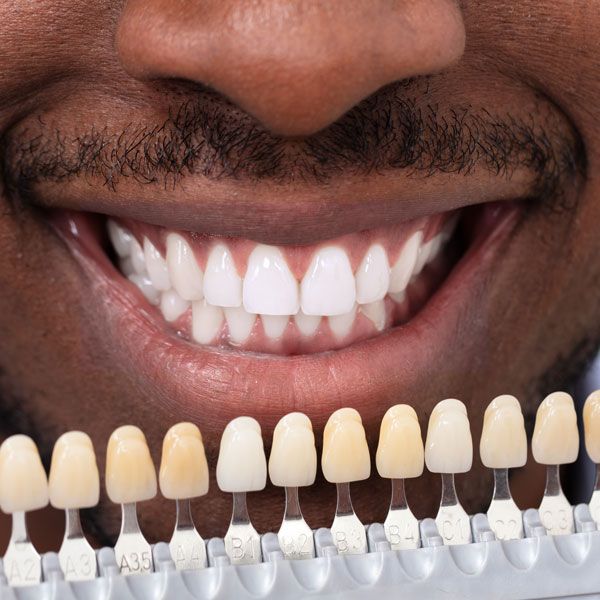 Teeth Whitening