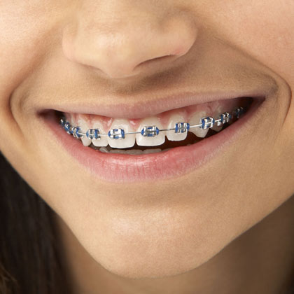 Metal braces