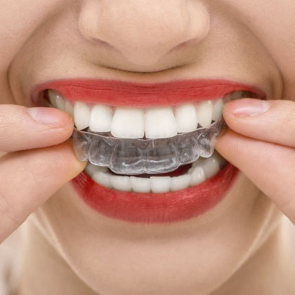 Invisalign