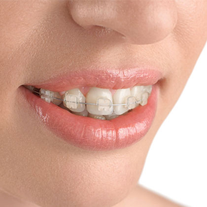 Clear Braces