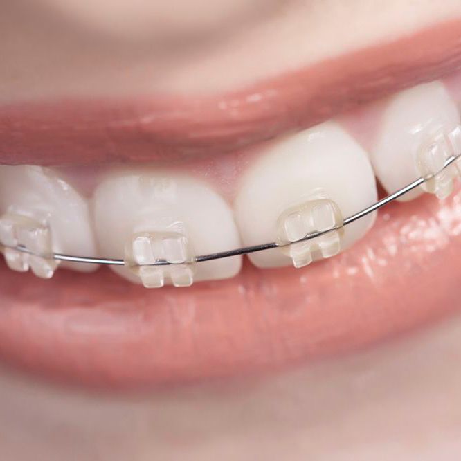 A person wearing ceramic braces