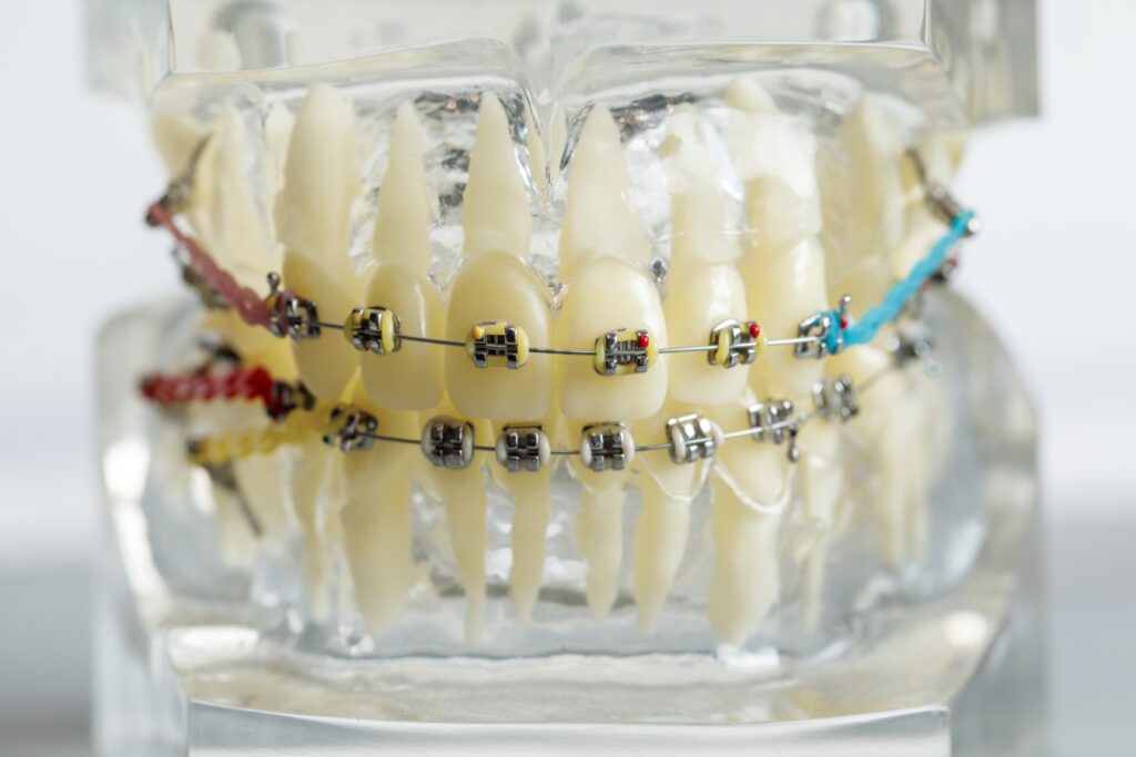 Braces 101: All You Need to Know - Scott Orthodontics